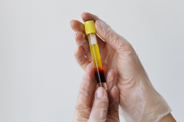 Lipid Test